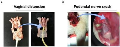 Combined Treatment With CCR1-Overexpressing Mesenchymal Stem Cells and CCL7 Enhances Engraftment and Promotes the Recovery of Simulated Birth Injury-Induced Stress Urinary Incontinence in Rats